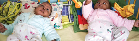 Madagascar’s Health Minister Separates Conjoined Twins